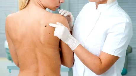 80% dintre românii cu melanom mai trăiesc maximum 5 ani de la depistarea afecţiunii