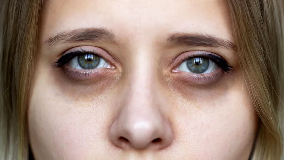 Cele 3 metode care te scapă imediat de cearcăne, potrivit experților dermatologi