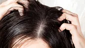 Scalp uscat? Remedii naturale care chiar funcționează