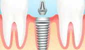 Implantul dentar: avantaje şi dezavantaje în raport cu alte metode de tratament