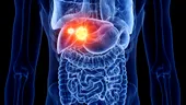 Chemoembolizarea hepatică, soluție pentru tumorile și metastazele din ficat