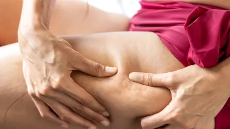 Boala ascunsă din spatele celulitei. Nu e doar despre piele