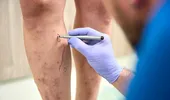 Vitamina care poate susține sănătatea vaselor de sânge și reduce riscul de varice