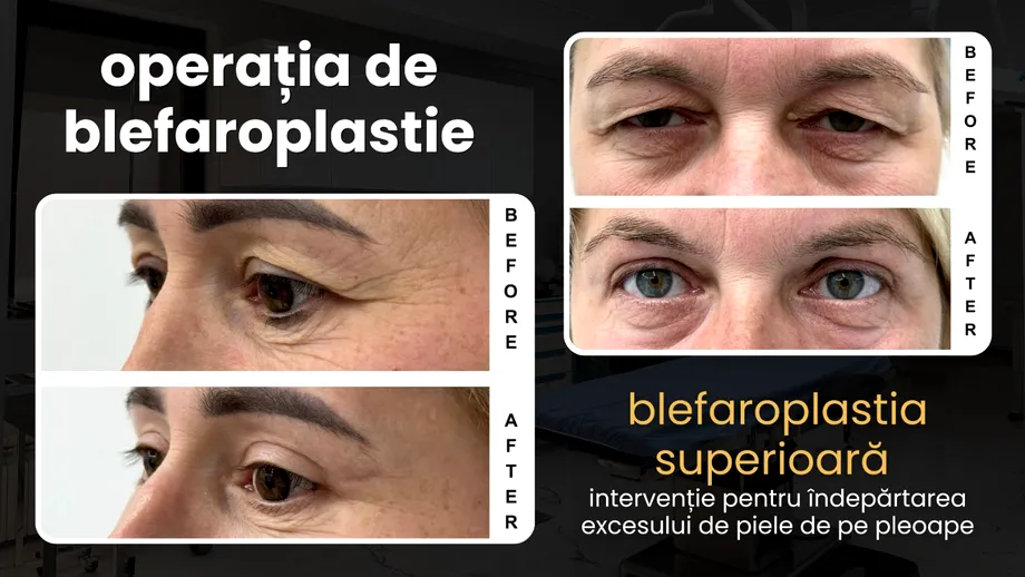 (P) Blefaroplastia superioară: de ce a devenit operația de pleoape cea mai realizată intervenție estetică din lume