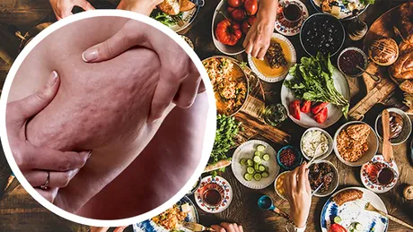 Cele 5 alimente din cauza cărora apare celulita. Ferește-te de ele și vei avea o piele fină și sănătoasă!