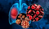 Cum deosebești o simplă răceală de pneumonie: semne care nu trebuie ignorate