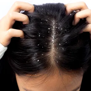 Remedii naturale pentru combaterea mătreții. Soluții simple pentru un scalp sănătos