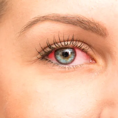 Melanomul ocular poate imita o infecție. Care sunt semnele și cum se tratează