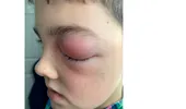 COVID-19: Un băiețel aproape a orbit din cauza unei infecții la ochi asociată cu coronavirus