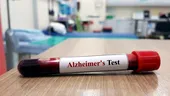 Demența, diagnosticată cu un test de sânge care oferă rezultatul în doar 15 minute