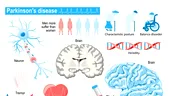Povara bolii Parkinson afectează peste 72.000 de pacienţi în România