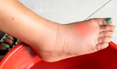 Efectul neașteptat al caniculei asupra picioarelor. De ce se umflă gleznele și cum poți preveni problema