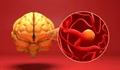 (P) Anevrismul cerebral: tratament minim invaziv prin neuroradiologie intervențională