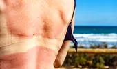 5 remedii naturale care calmează rapid arsurile solare. Ce poți aplica imediat pe piele