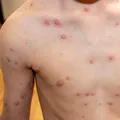Rujeola, mai aproape de un tratament? Cercetătorii au identificat anticorpi care neutralizează virusul