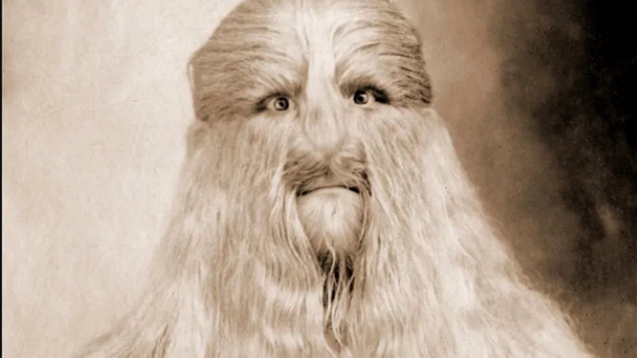 Povestea lui Lionel „Față de Leu”. Boala rară cu care a fost diagnosticat