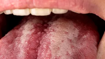 Cum se reflectă refluxul acidului gastric la nivelul dinților