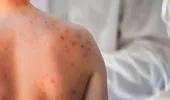 Pielea care „ține minte” stresul: cum se vede anxietatea pe ten