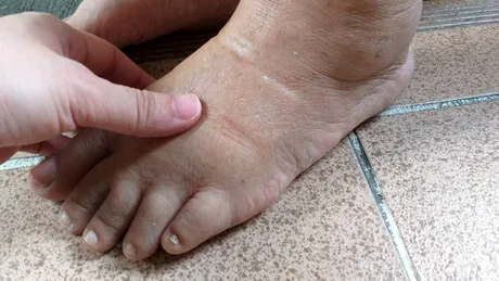 Ce să mănânci să scapi de retenția de apă și balonarea din timpul verii. Alimente care elimină fluidele toxice din corp