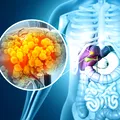 Cancerele digestive, de la diagnostic la tratament. „S-a observat o creștere a incidenței în rândul tinerilor”