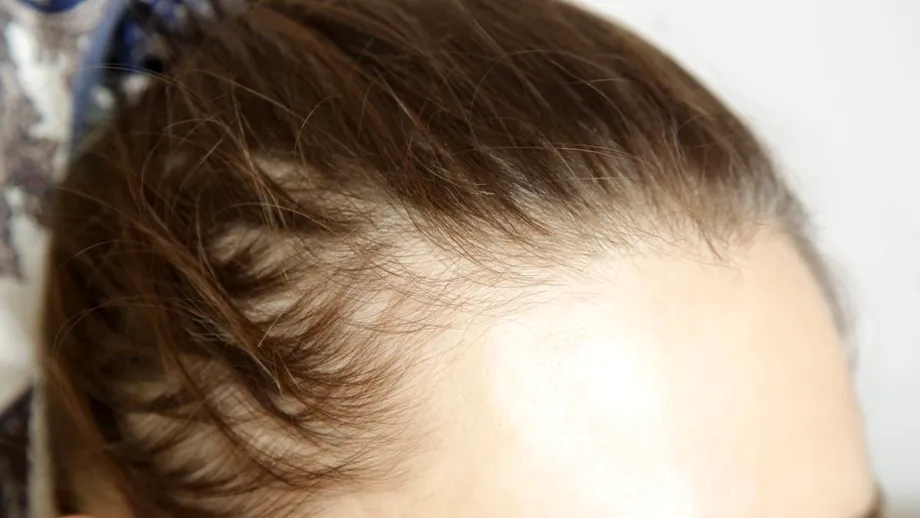 Slăbești, dar îți cade părul? Ce legătură au injecțiile pentru slăbit cu alopecia