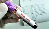 De ce poate crește hemoglobina glicată (HbA1c)? Glicemia ridicată nu este singura explicație