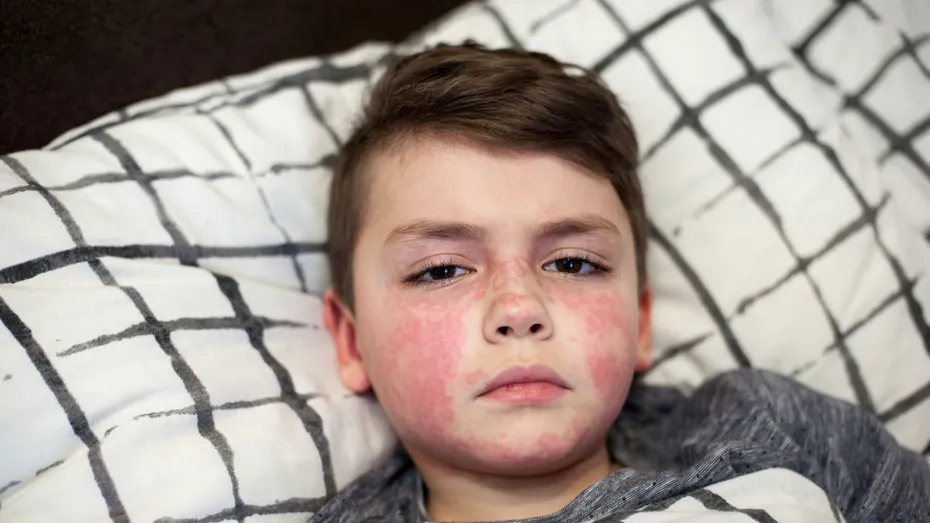 Un elev de 15 ani din Iași, suspect de scarlatină! Ce simptome trebuie să urmărească părinții, potrivit medicilor
