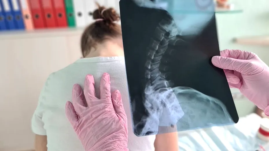 Cele 4 semne vizibile care pot indica scolioza la copii. Afecțiunea apare frecvent între 10 și 15 ani