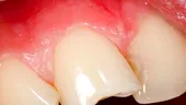 Ce facem în cazul unei fracturi dentare accidentale?