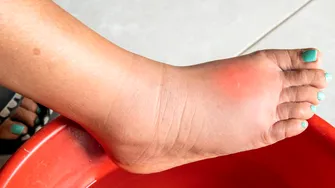 Ceaiul care tratează senzația de picioare grele