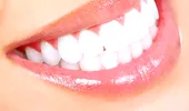 Faţete dentare, de ultimă generaţie. Se aplică direct pe dinte, nu mai necesită şlefuire!