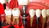 Ce trebuie să știe pacientul care a pierdut mai mulți dinți și are nevoie de tratament cu implanturi dentare și adiție de os