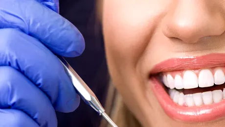 Faţete dentare: cât de complex este procesul pentru un zâmbet perfect