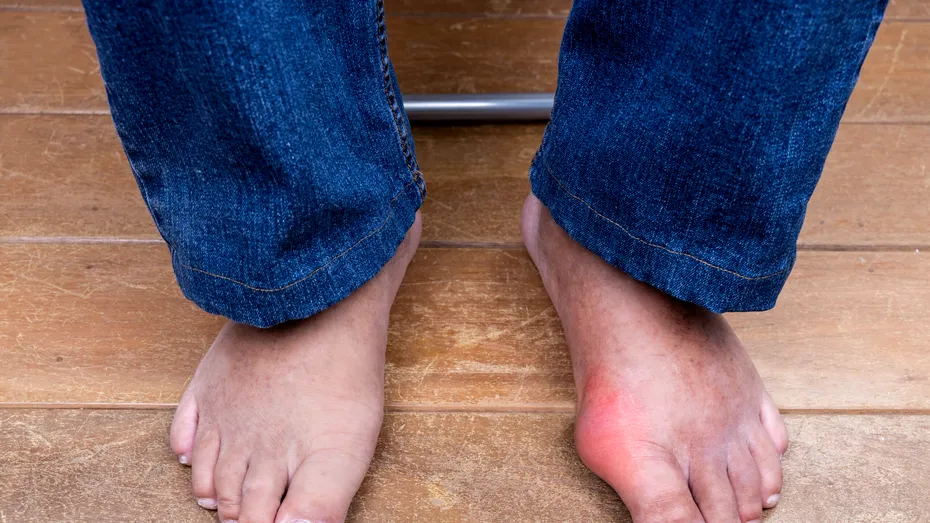 Dieta pentru gută: meniu pe 7 zile. Ce să mănânci să reduci acidul uric în exces