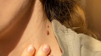O femeie a învins melanomul după ce și-a scos 100 de alunițe