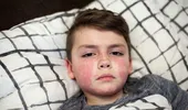 Un elev de 15 ani din Iași, suspect de scarlatină! Ce simptome trebuie să urmărească părinții, potrivit medicilor