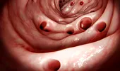 Top 5 cele mai frecvente boli ale colonului și semnele pe care le dau