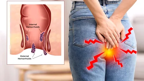 Ce să mănânci pentru a reduce riscul de cancer colorectal. Alimentele recomandate la micul dejun, prânz și cină și ce ar trebui să eviți