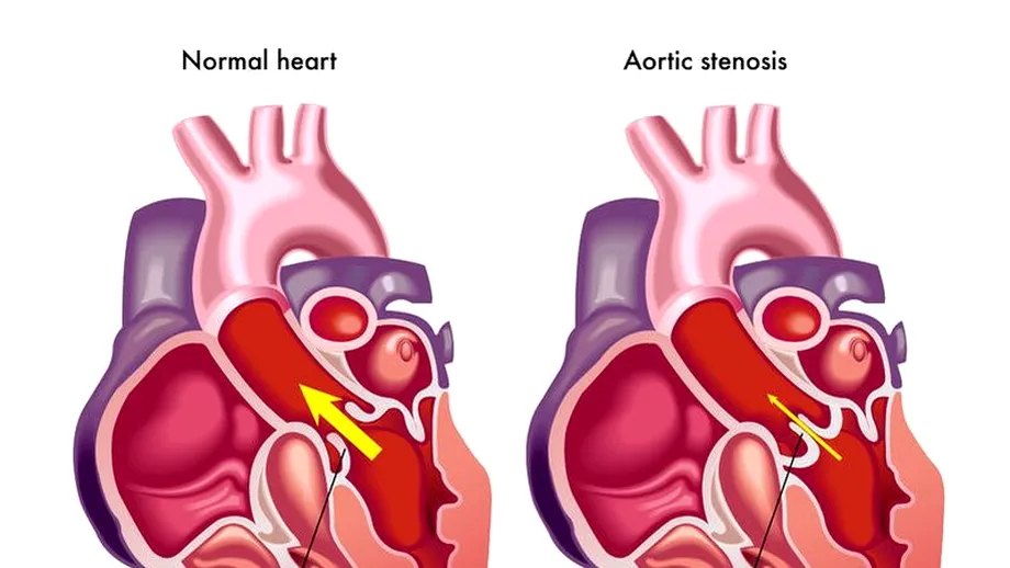 Stenoza valvulară aortică: tratament