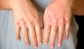 Semnul că tratamentul tău pentru psoriazis nu mai funcționează. Medicii spun când trebuie schimbat