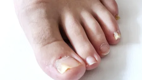 Onicomatricom: cauze, simptome, tratament