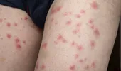 Ciuma sau „moartea neagră”, boala care se transmite prin ciupitura de purici infectați și se manifestă ca gripa