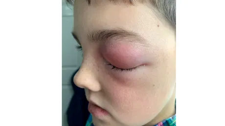 COVID-19: Un băiețel aproape a orbit din cauza unei infecții la ochi asociată cu coronavirus