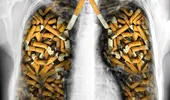 Primul simptom în cancerul pulmonar nu e tusea! Altceva trebuie să te îngrijoreze