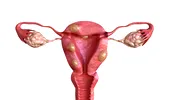 Fibrom uterin – 7 semne și simptome supărătoare