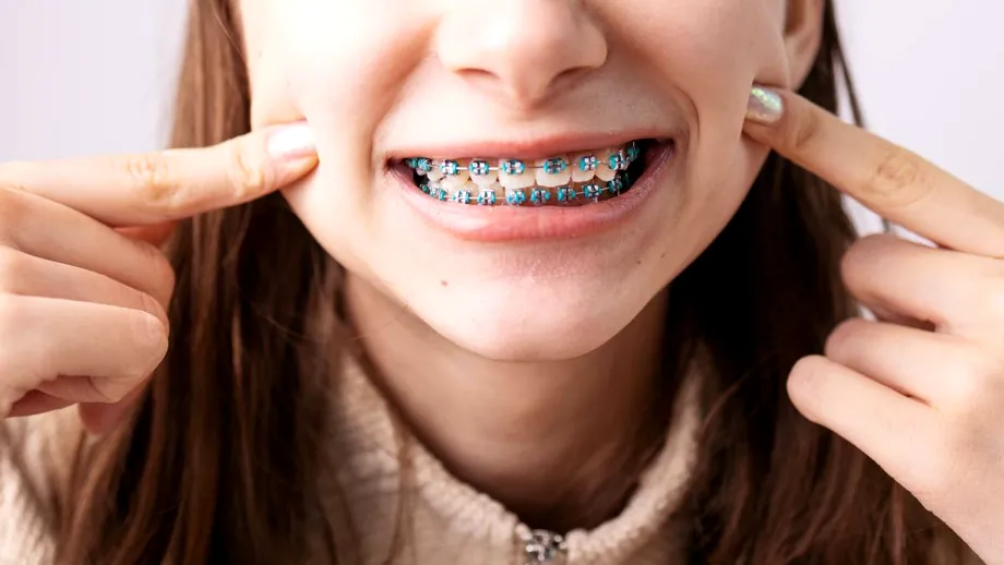 Forța de frecare în aparatele ortodontice: ce înseamnă, de ce contează și ce ar trebui să știe pacienții