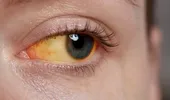 Ce îți spune „mucusul ocular” despre sănătatea ochilor: culorile care indică un semnal de alarmă