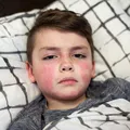Un elev de 15 ani din Iași, suspect de scarlatină! Ce simptome trebuie să urmărească părinții, potrivit medicilor