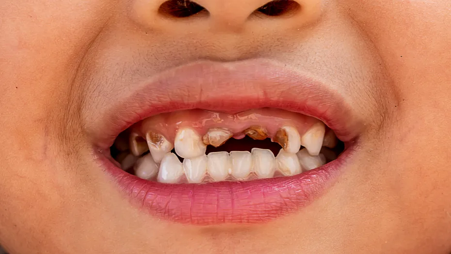 Cel mai nociv aliment pentru dinți. Medic: Se transformă într-un acid care atacă smalțul