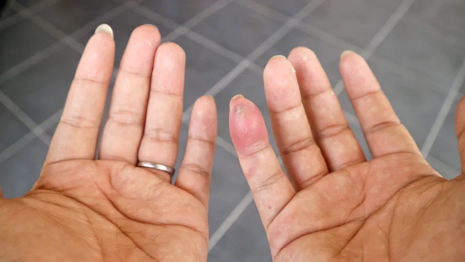 Cum îți dai seama că te-a mușcat un păianjen. Simptome și tratament în caz de mușcătură de păianjen